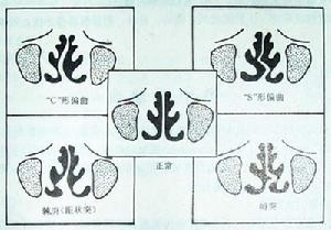 原三甲医生详解：鼻中隔偏曲主要症状有哪些？